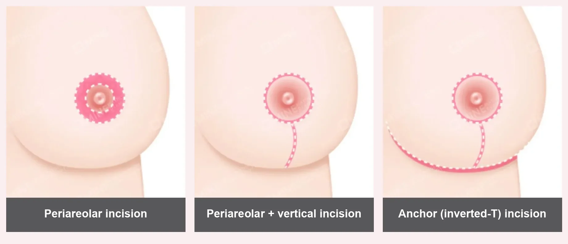 Illustration of where mastopexy scars sit for periareolar, periareolar plus vertical, and anchor inverted-T incisions