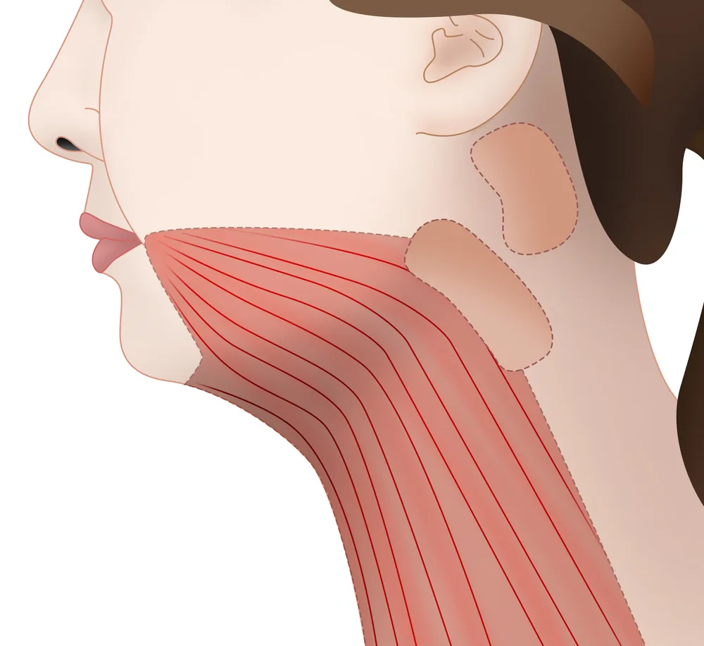 Side-view illustration of the face and neck with the platysma muscle highlighted, an area outside the scope when asking how long does a mini facelift last