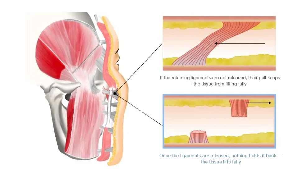 Retaining ligament illustration for how long does a mini facelift last: tissue held back while ligaments stay attached versus lifting fully once released