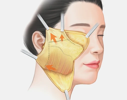 Illustration of the SMAS layer lifted upward and backward toward the ear, the deep-layer fixation behind how long does a mini facelift last