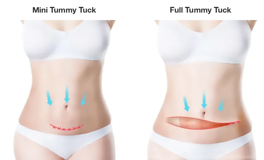 Mini tummy tuck scar compared with a full tummy tuck scar: a short low line versus a longer excision line