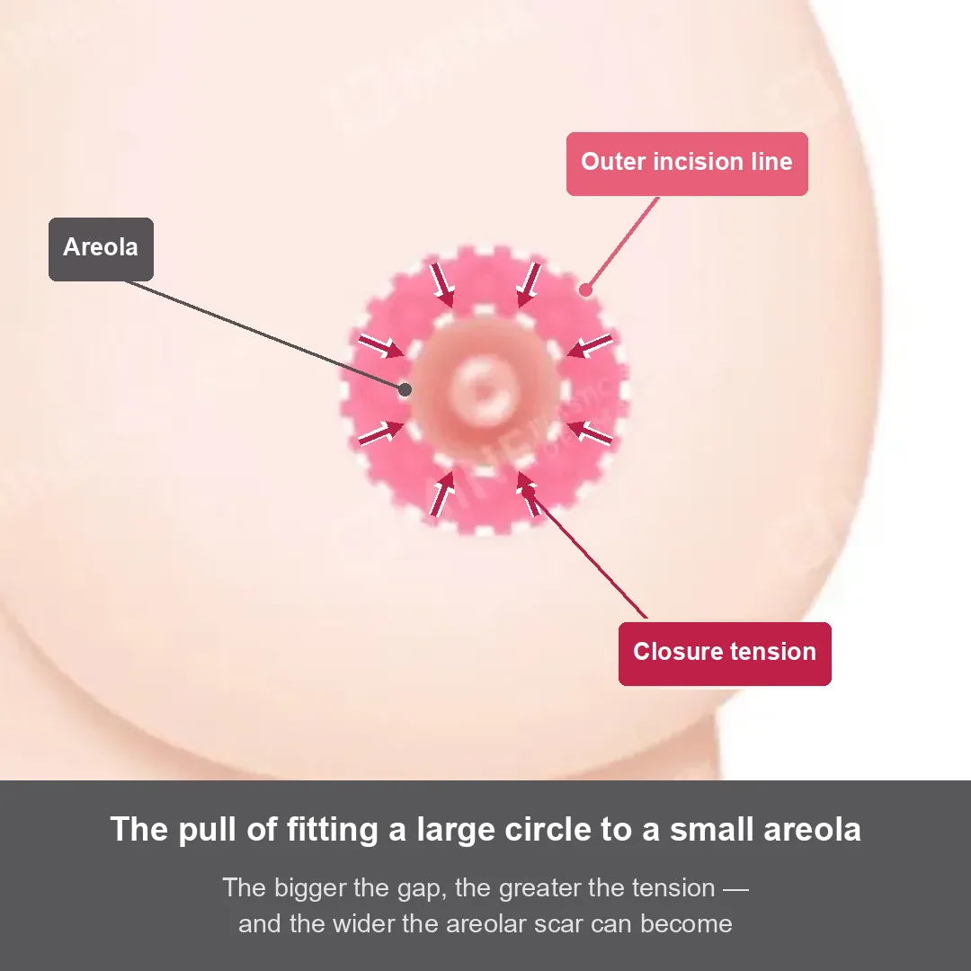 Illustration of closure tension when a large outer circle is fitted to a smaller areola in a periareolar incision