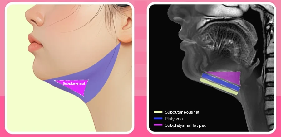 Illustration and MRI of the neck marking subcutaneous fat, the platysma muscle and the deep fat pad beneath it