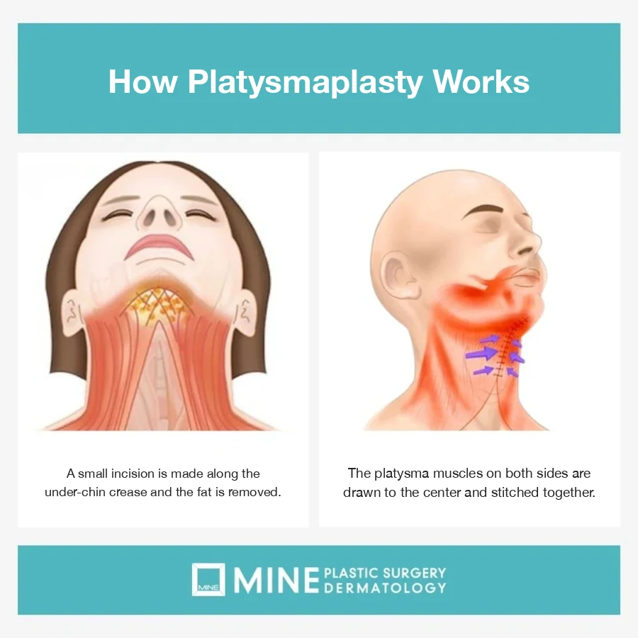 Diagram of platysmaplasty: both platysma muscles drawn to the midline and stitched together