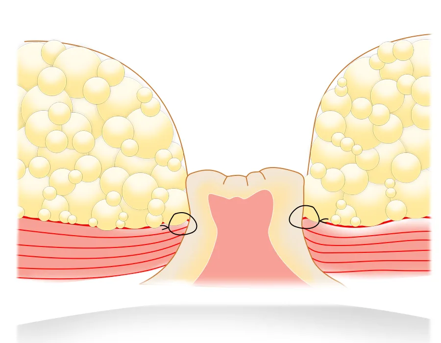 Tummy tuck scar around the belly button: cross-section diagram of navel reconstruction in a full tummy tuck, with the navel stalk sutured to the abdominal fascia