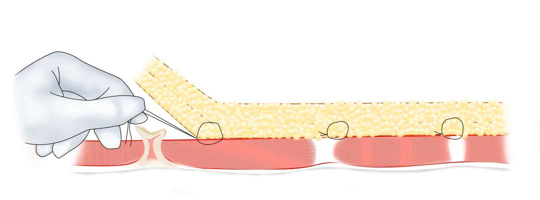 Progressive tension sutures fixing the underside of the abdominal skin flap at several points to keep the tummy tuck scar from widening