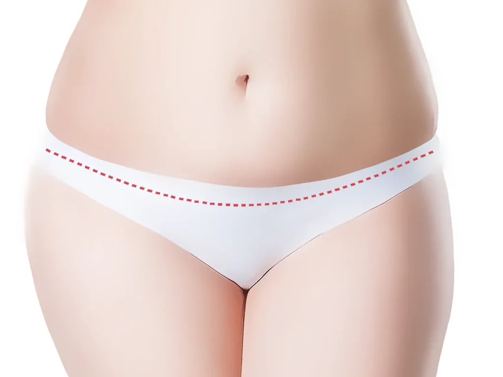 Tummy tuck scar illustration showing the incision line marked low inside the underwear line
