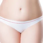 Tummy tuck scar illustration showing the incision line marked low inside the underwear line