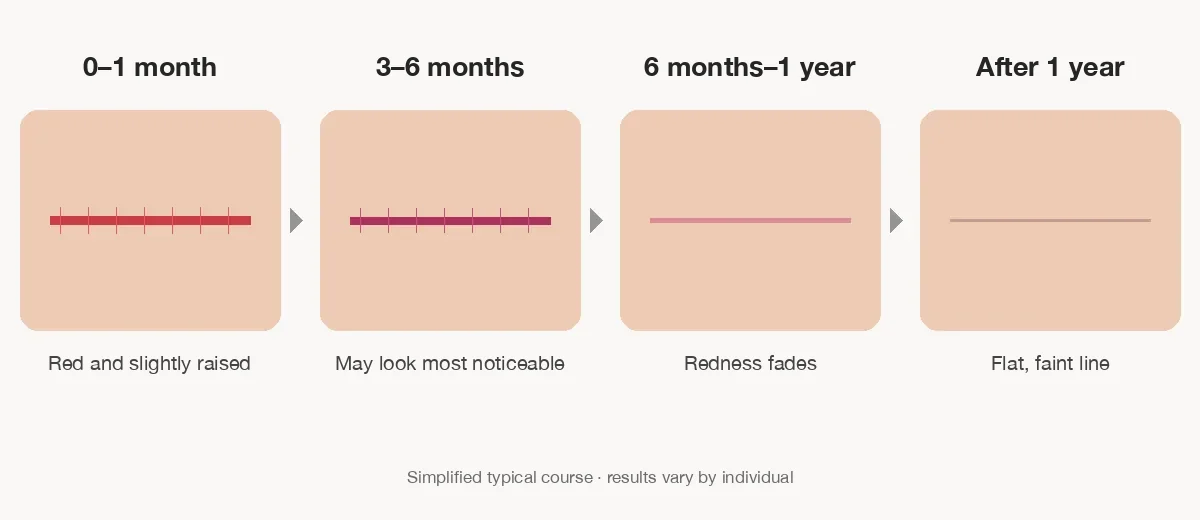 Tummy tuck scar healing timeline from right after surgery to after 1 year, showing the scar turning from red and raised to a flat, faint line
