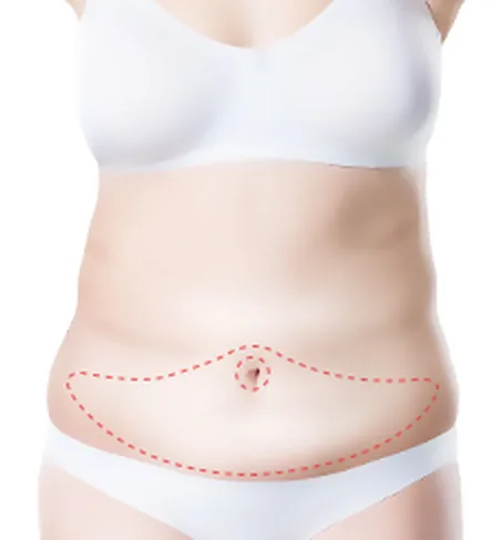Full tummy tuck incision design showing where the tummy tuck scar forms: a low horizontal line and a ring around the belly button