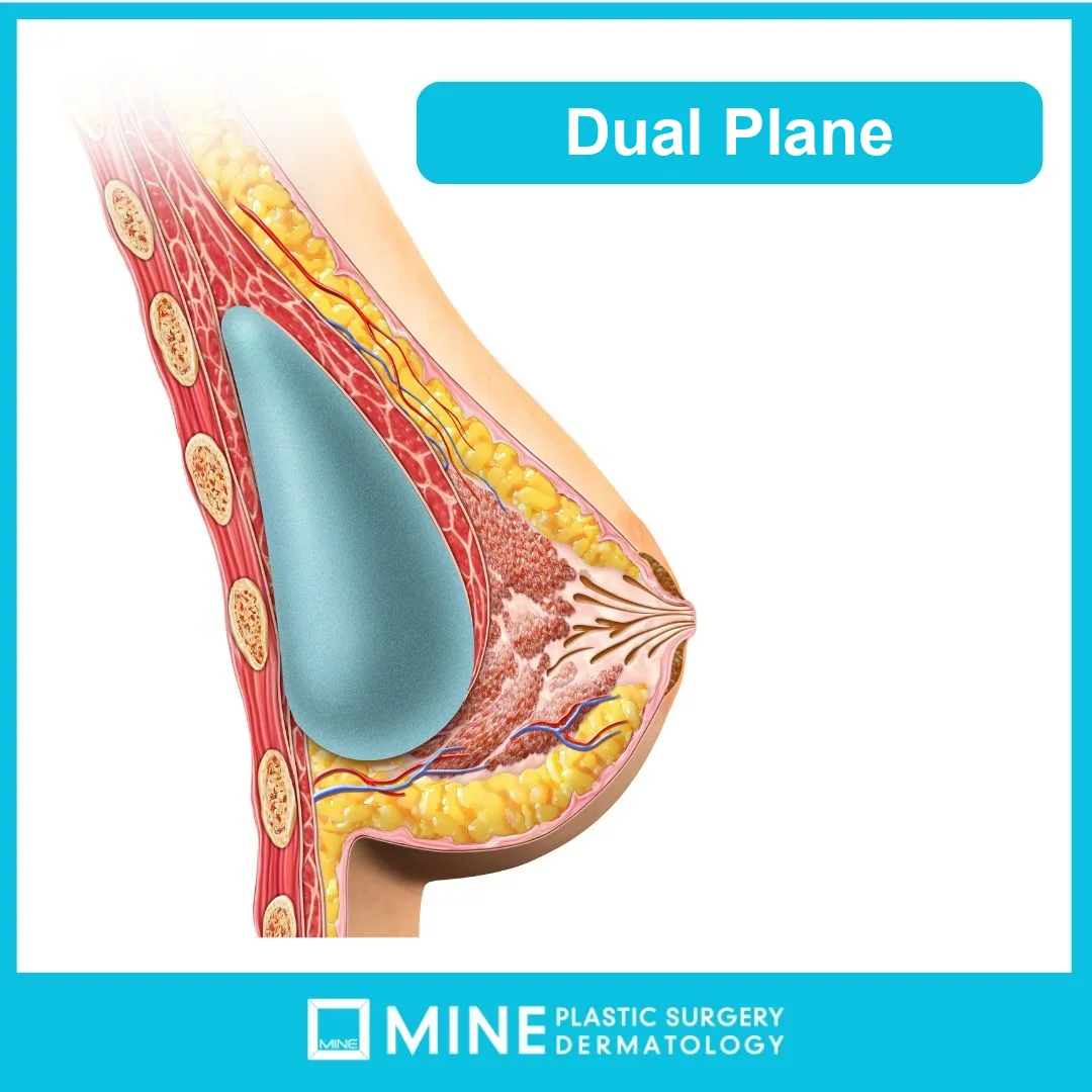 Cross-section diagram of the dual plane technique used in implant-based types of breast surgery, with the implant partly under the chest muscle