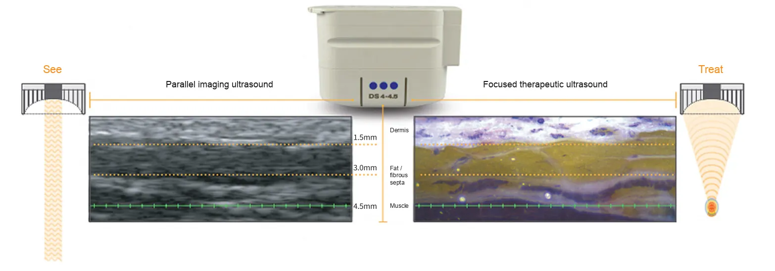 DeepSEE diagram: imaging ultrasound shows the dermis, fat and muscle at 1.5, 3.0 and 4.5 mm before focused ultrasound treats, guiding where and how many Ultherapy shots are placed