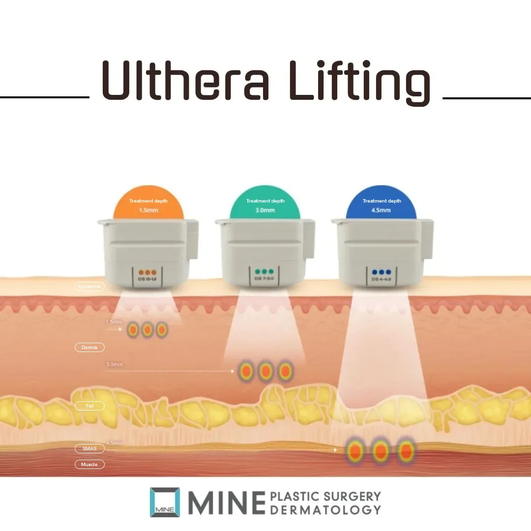 Ultherapy for men transducer depths of 1.5 mm, 3.0 mm and 4.5 mm targeting the dermis and SMAS layer
