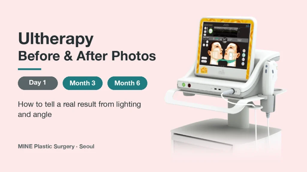 Ultherapy before and after photos guide: Ulthera device with Day 1, Month 3 and Month 6 time points