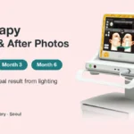 Ultherapy before and after photos guide: Ulthera device with Day 1, Month 3 and Month 6 time points