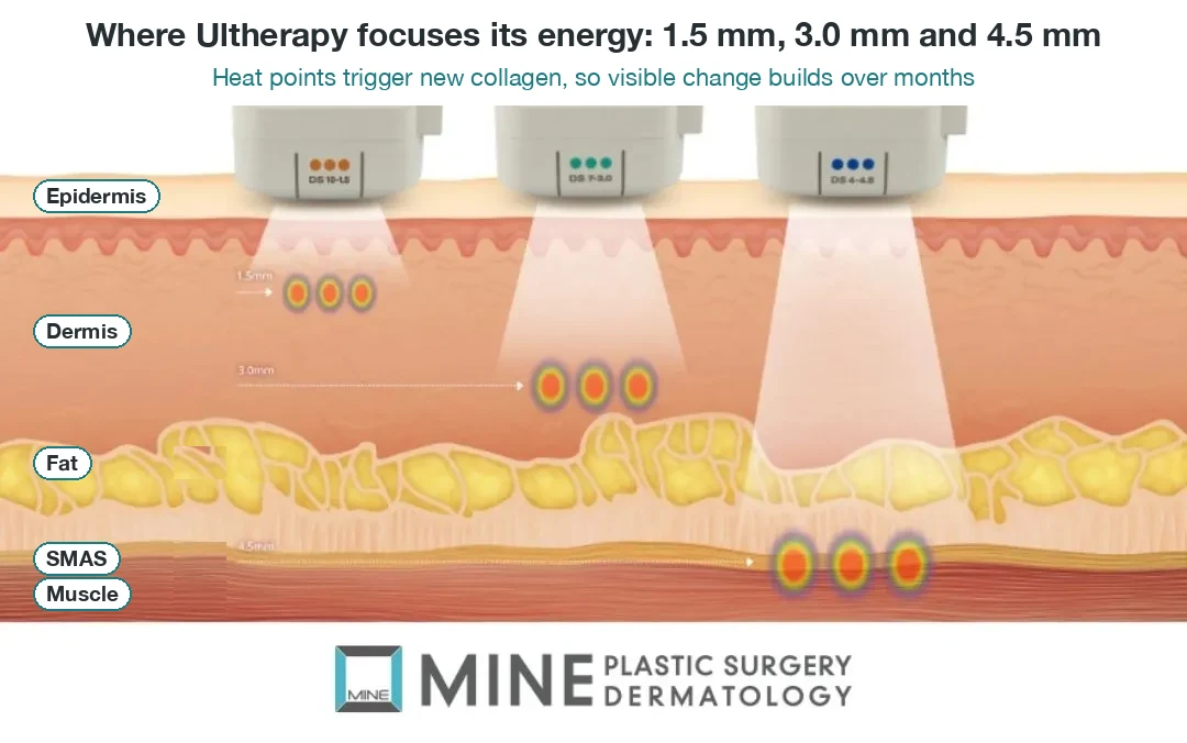 Diagram of Ultherapy focal points at 1.5 mm, 3.0 mm and 4.5 mm in the dermis and SMAS layer, showing why changes build over months