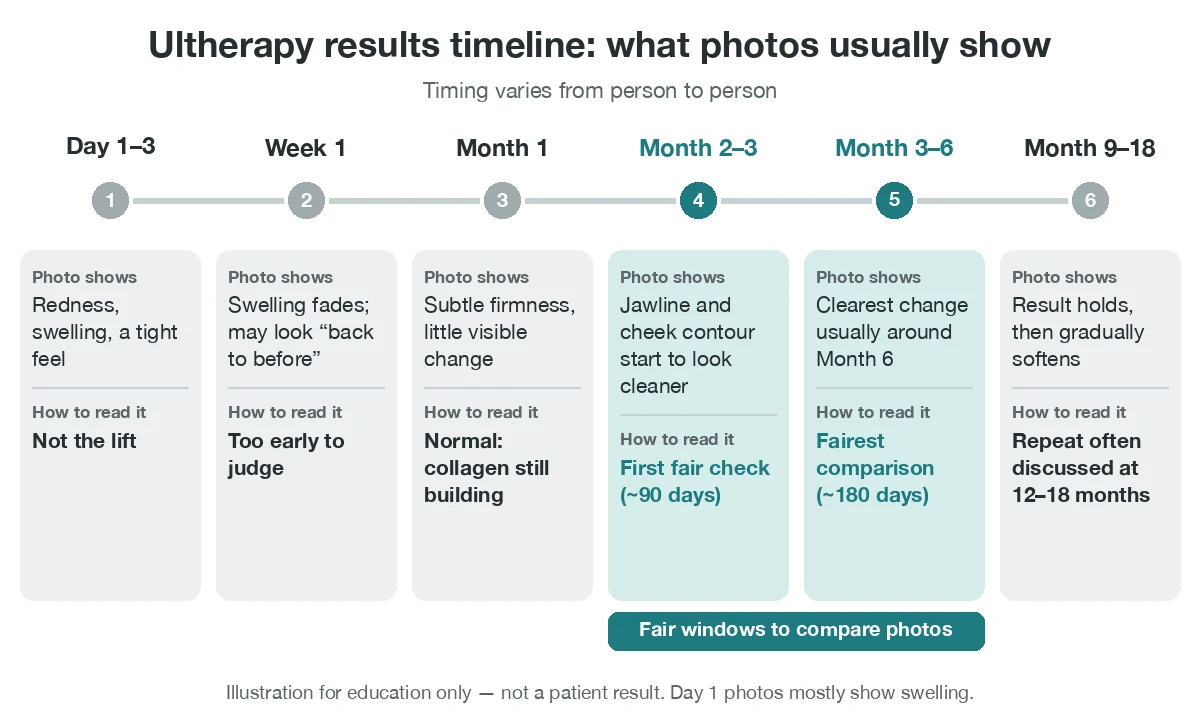Ultherapy results timeline infographic showing what photos usually show, from Day 1 swelling to the clearest change around Month 6