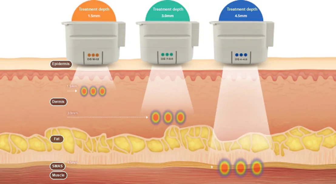 Diagram of the three Ultherapy transducer depths, 1.5 mm, 3.0 mm and 4.5 mm, and the skin layers they reach, which shape how many Ultherapy shots are planned