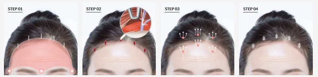 Endoscopic brow lift in 4 steps: small scalp incisions, endoscopic release, brow elevation and fixation, closure