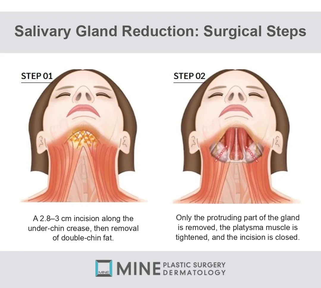 Salivary gland removal surgical steps: under-chin crease incision, partial removal of the protruding gland and platysma tightening