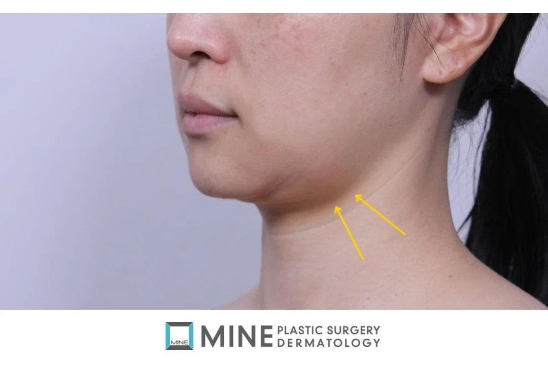 Side view with arrows marking the bulge below the jawline where the submandibular gland sits, the area salivary gland removal targets