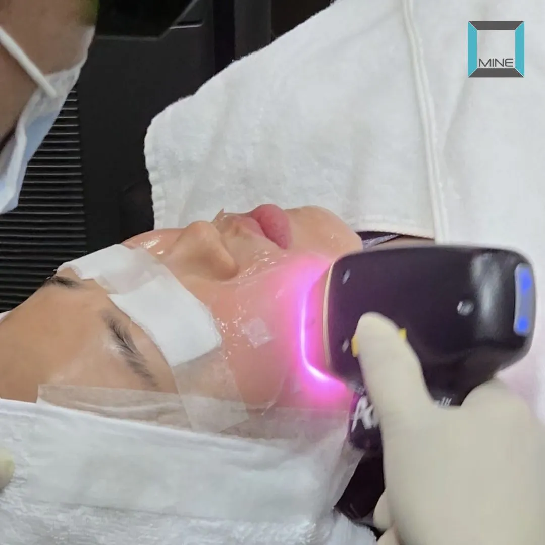 Titanium Lifting treatment in progress with the laser handpiece on the lower face along the jawline and the patient's eyes protected