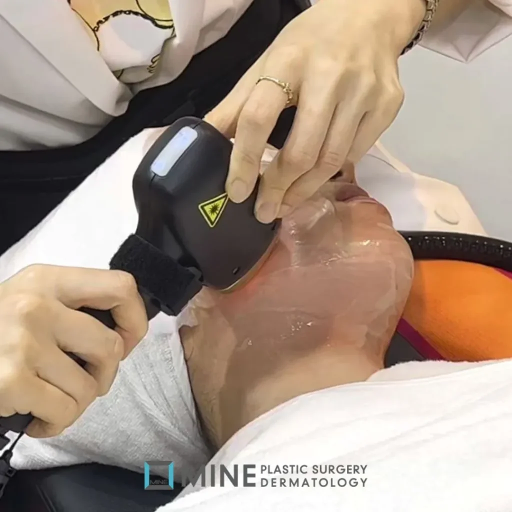 Titanium Lifting diode laser handpiece being applied under the jawline over a layer of cooling gel