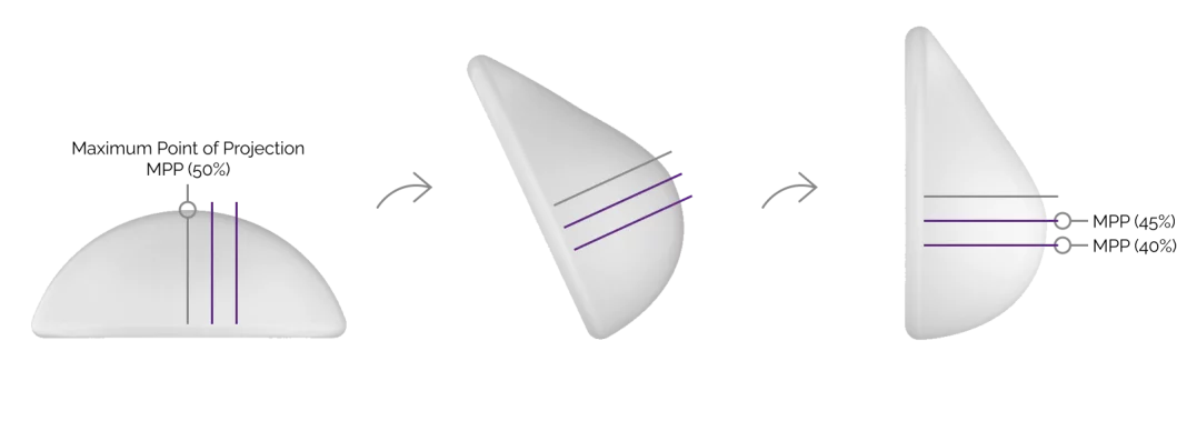 Motiva Korean breast augmentation implant's natural movement.