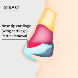 Remove part of the long wing cartilage to correct long nose.