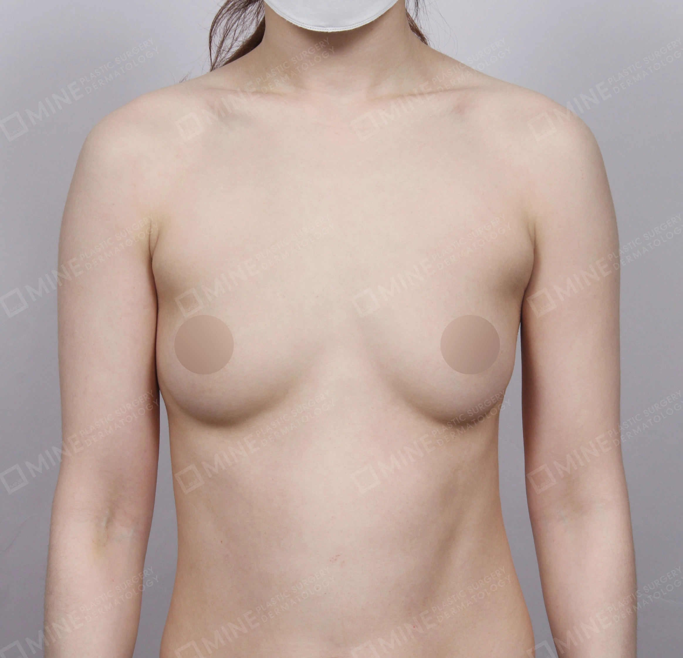 Breast Augmentation-정면-전