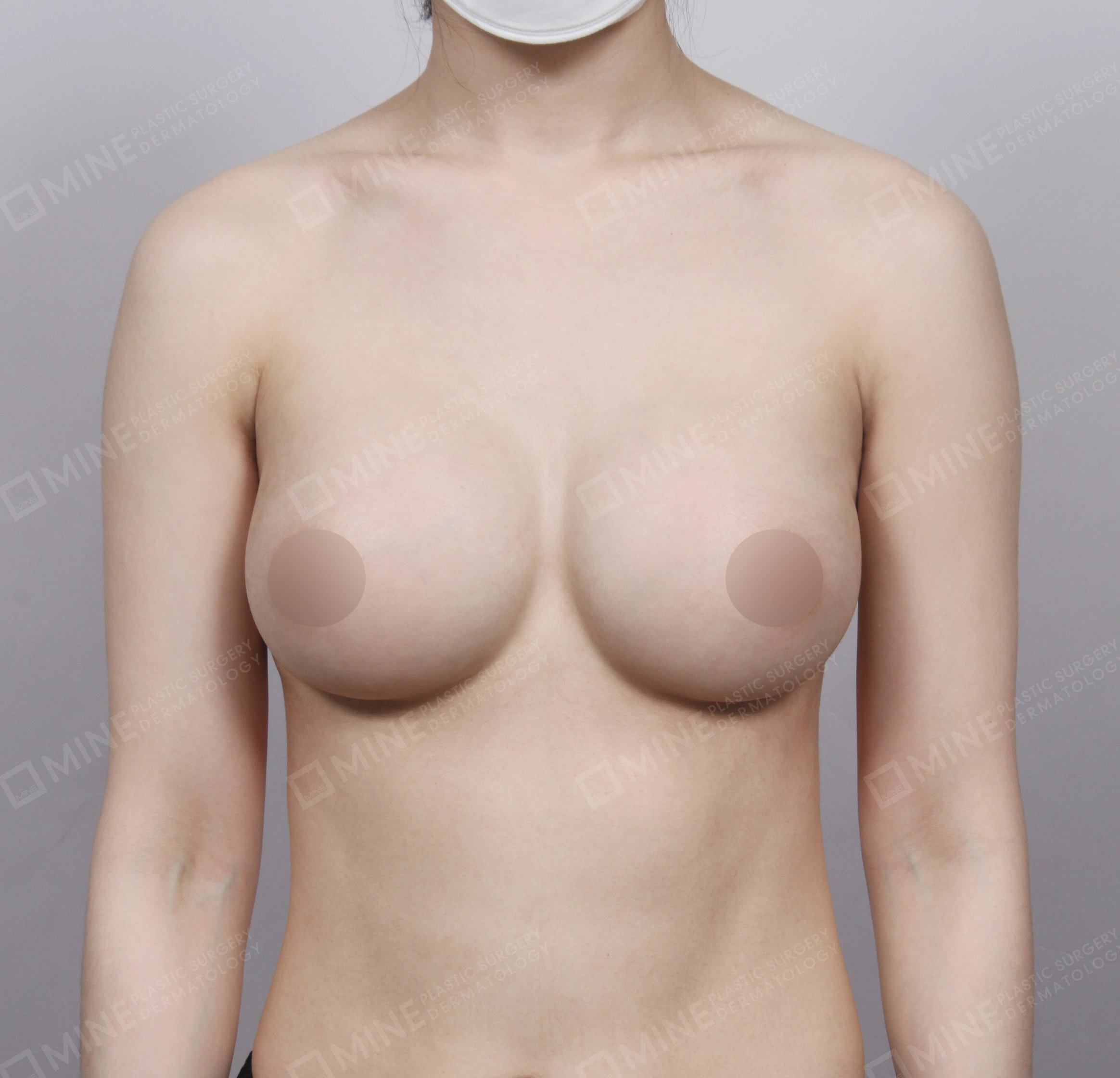 Breast Augmentation-정면-후