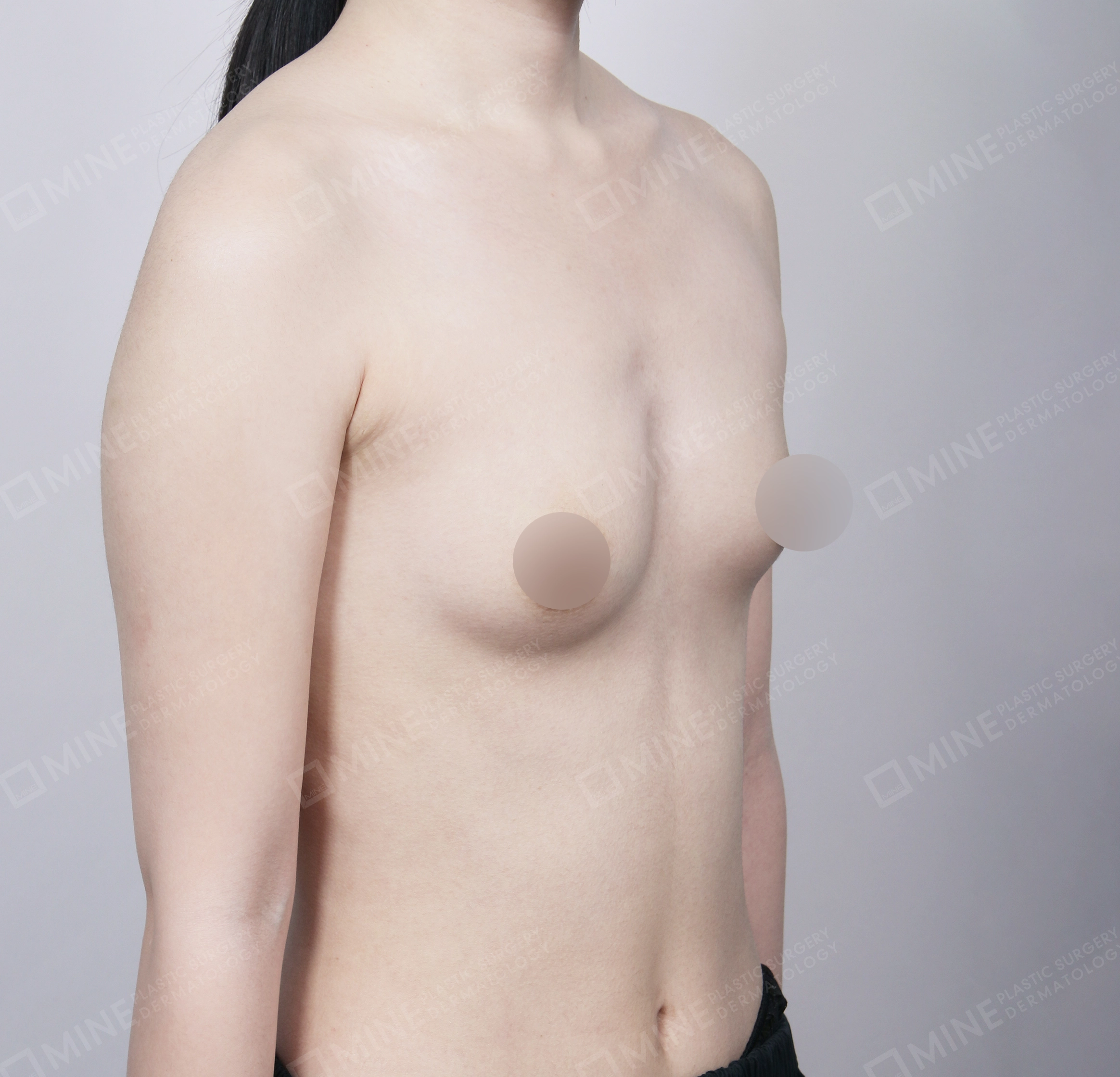 Breast Augmentation-45도-전