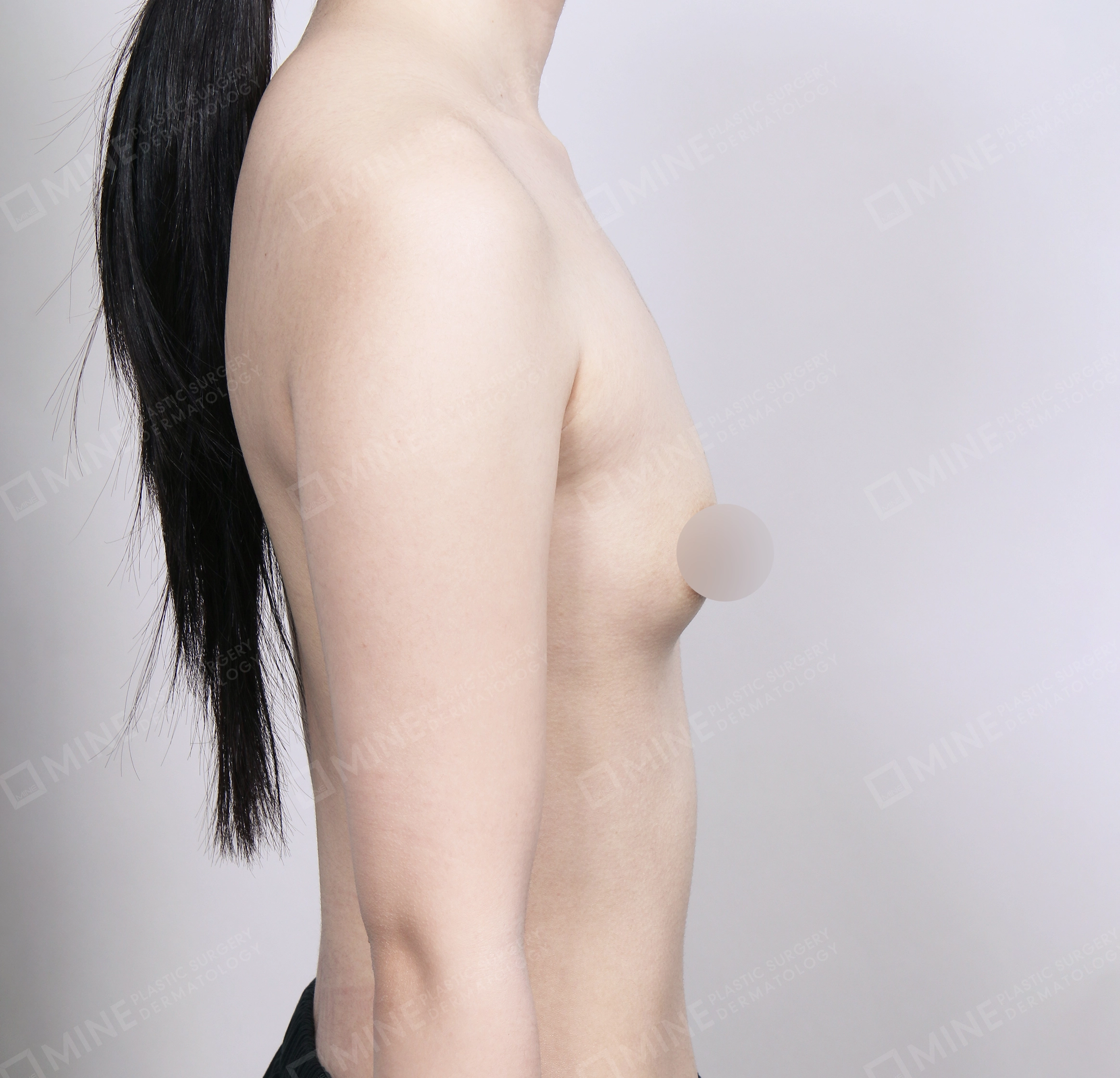 Breast Augmentation-측면-전