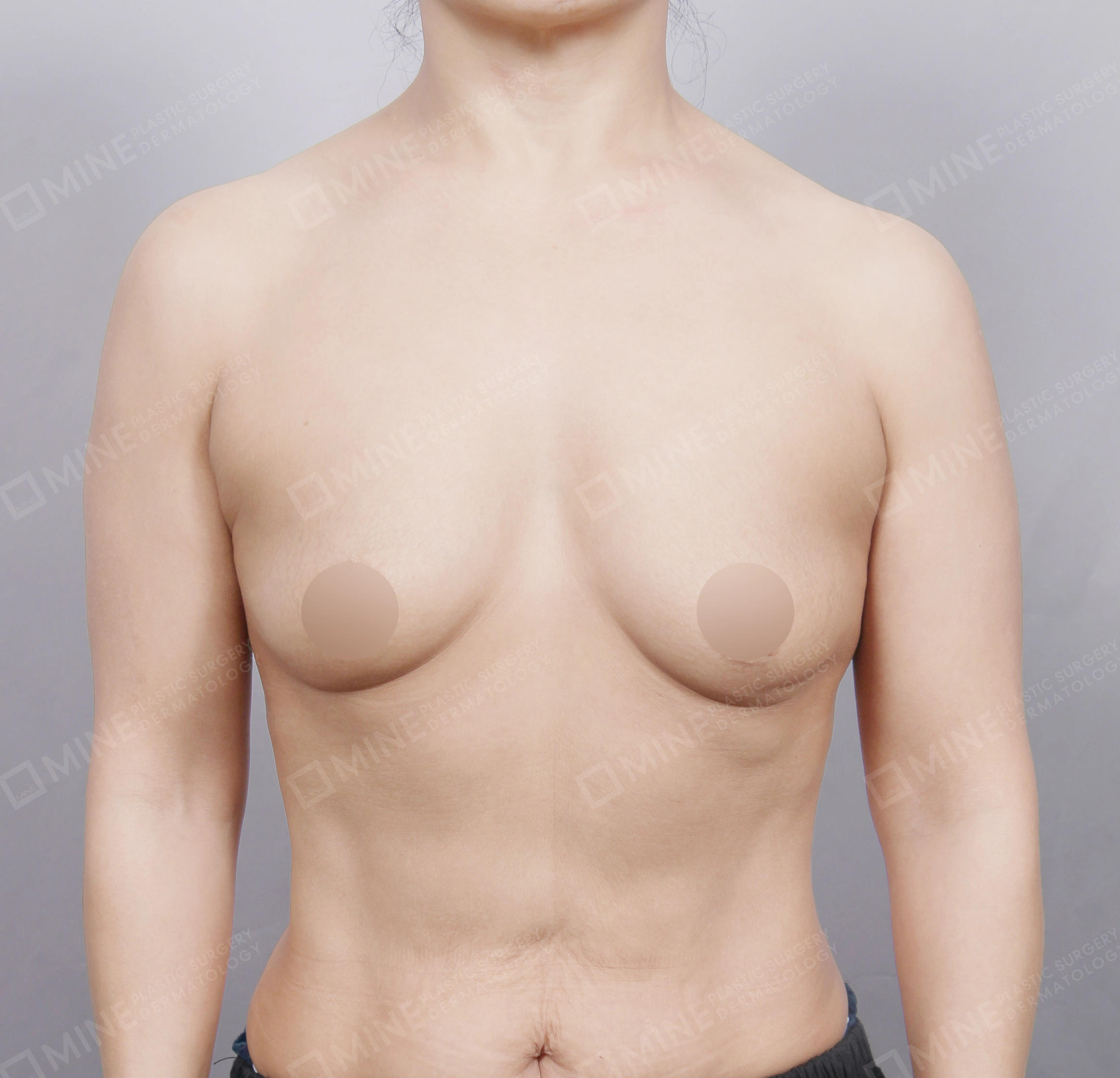 Breast Augmentation-정면-전