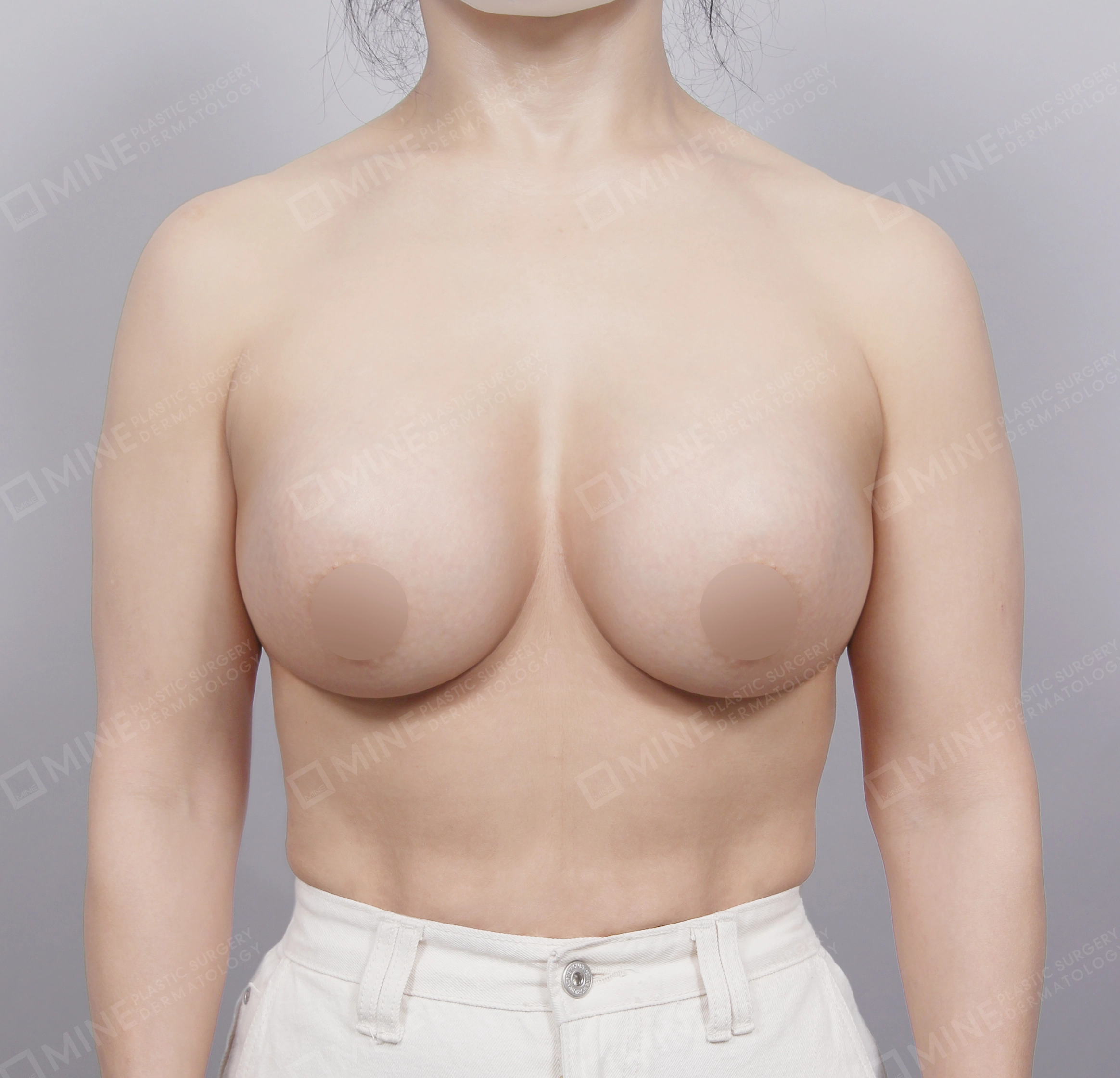 Breast Augmentation-정면-후