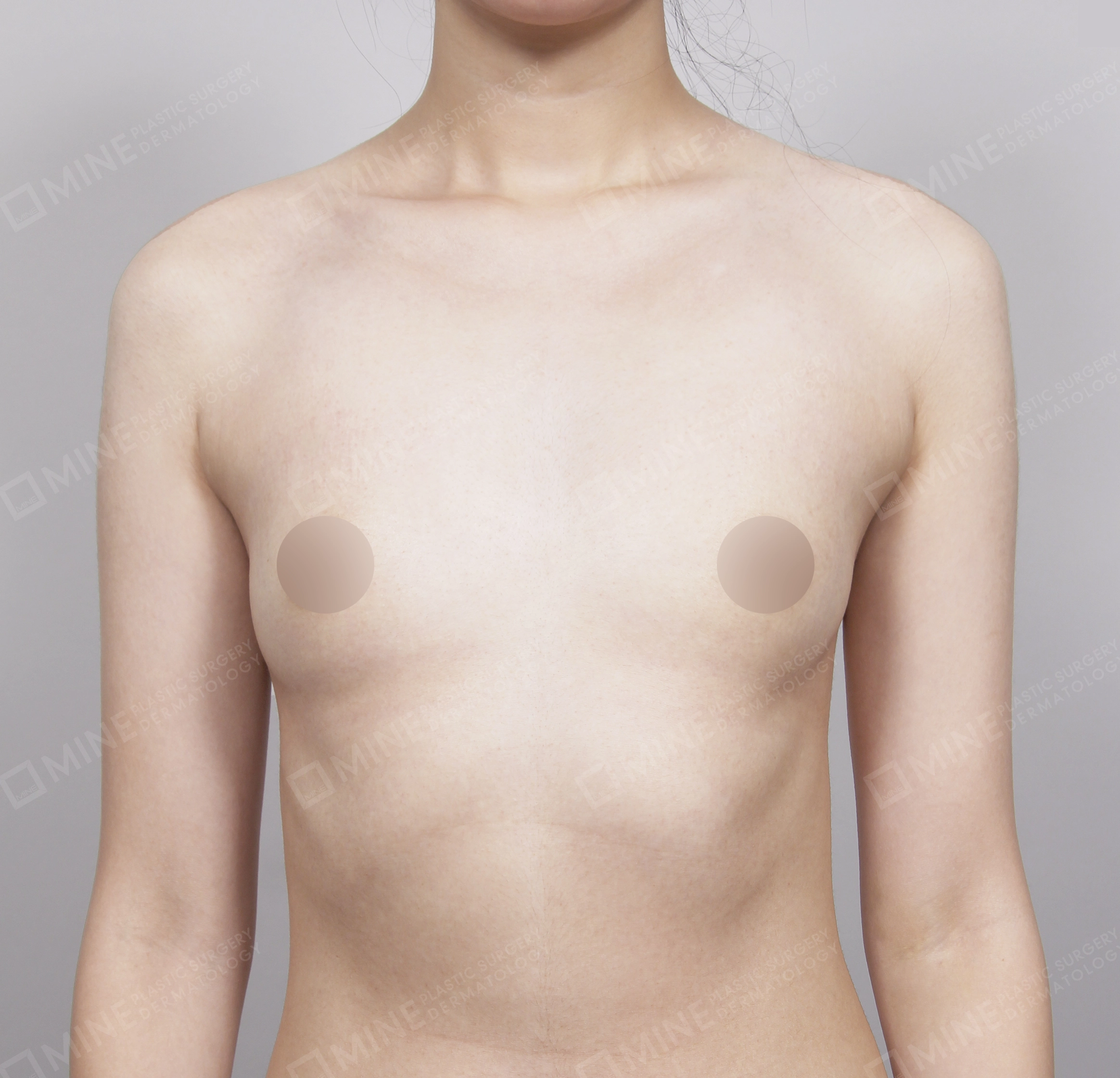 Breast Augmentation-정면-전