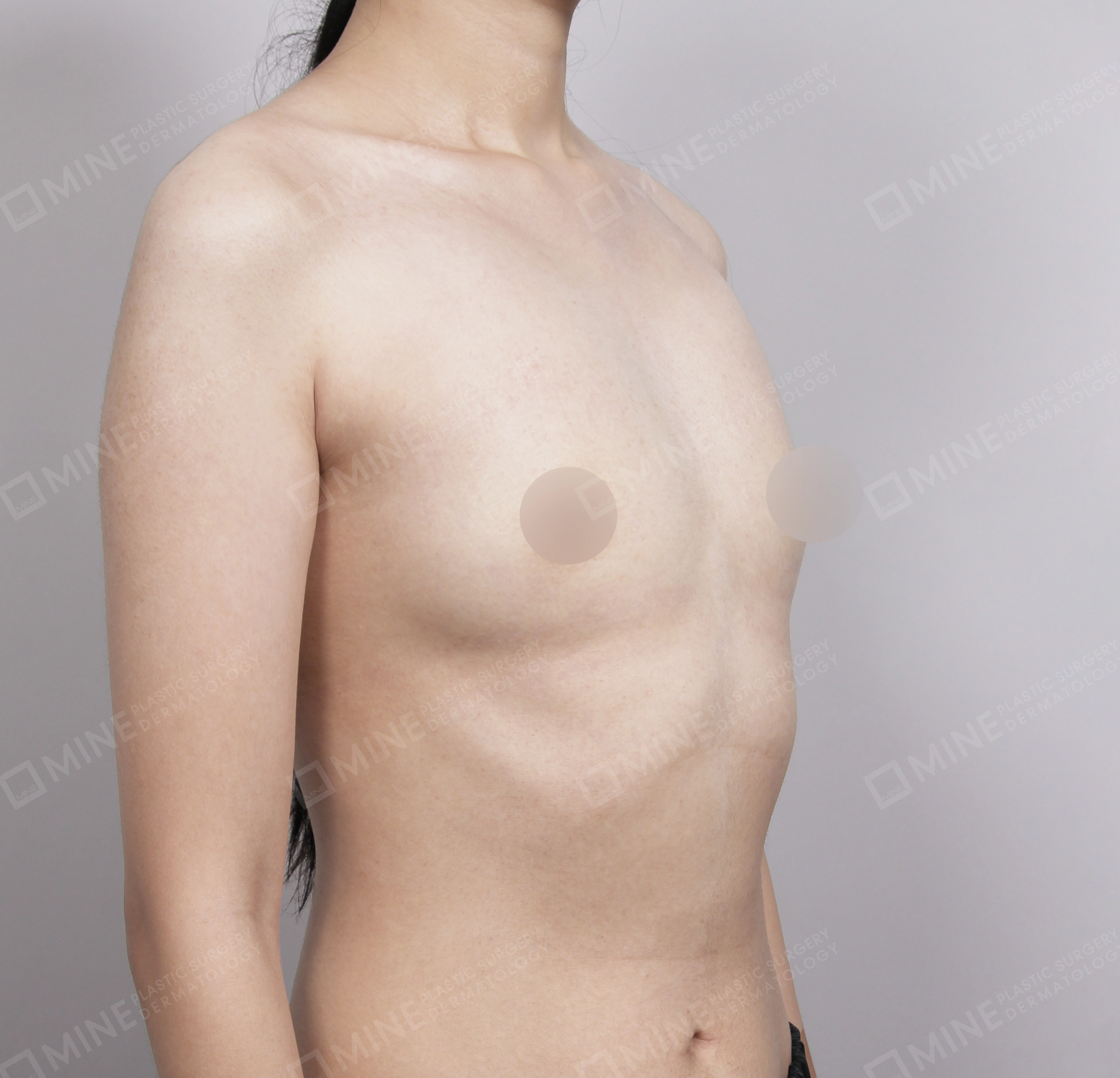Breast Augmentation-45도-전