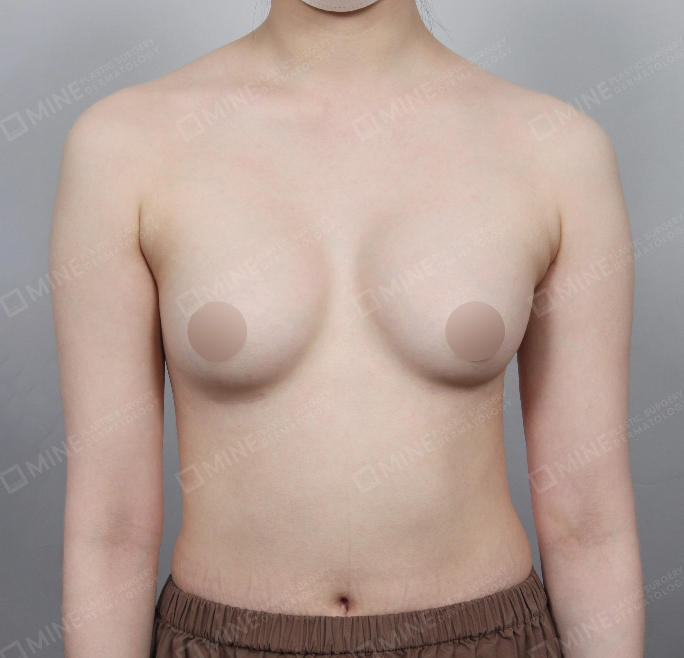 Breast Revision-Front-Before