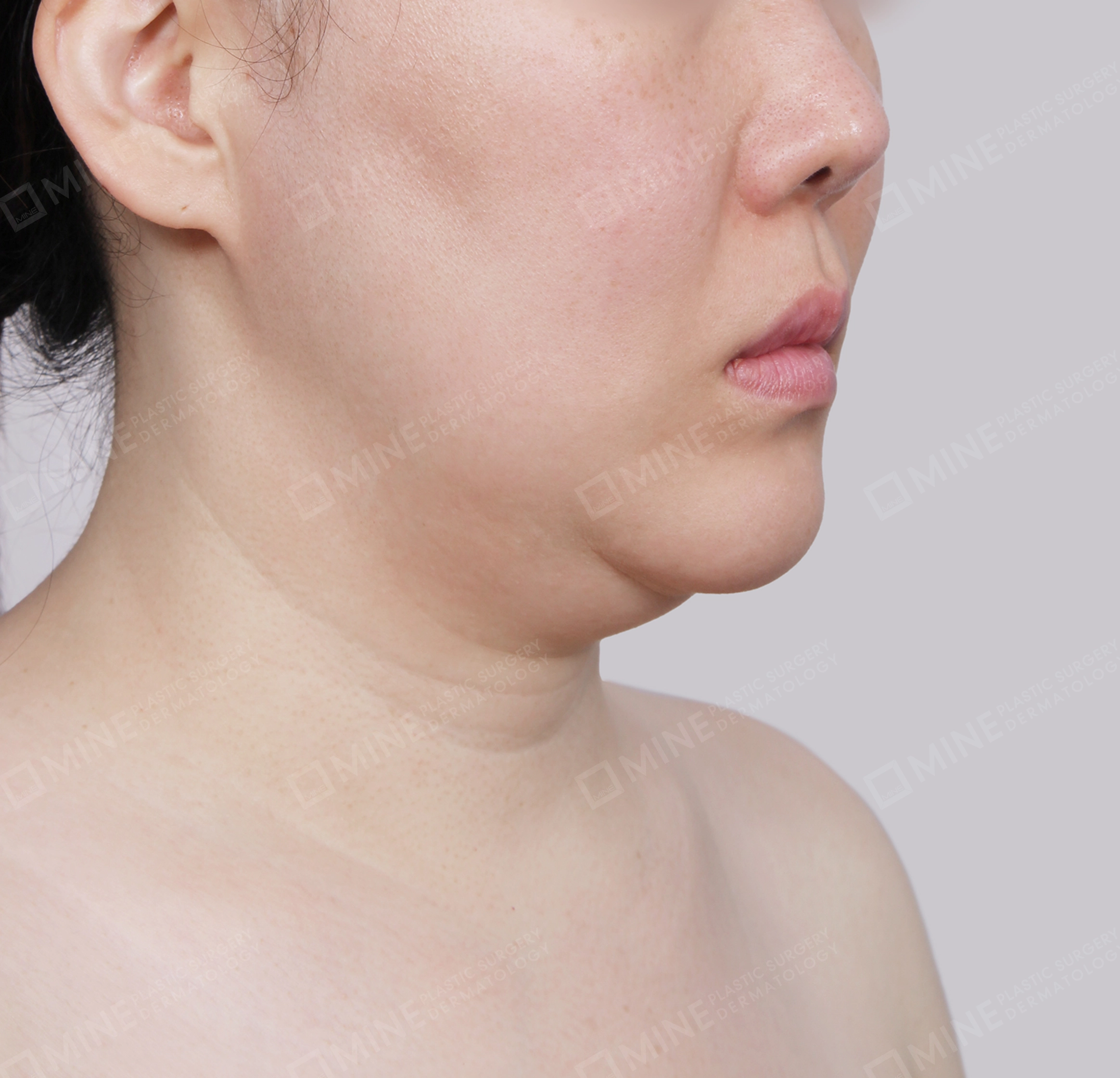 Mini Neck Lift-Front-Before