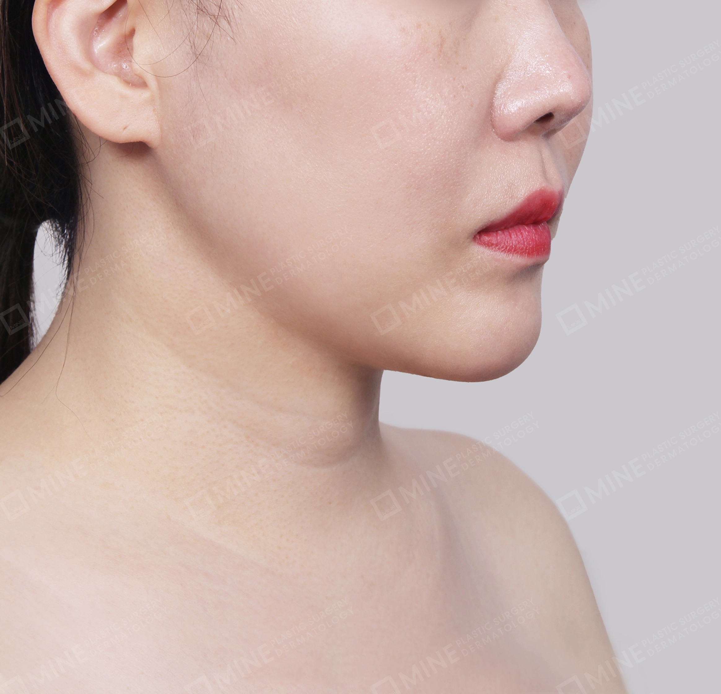 Mini Neck Lift-Front-After