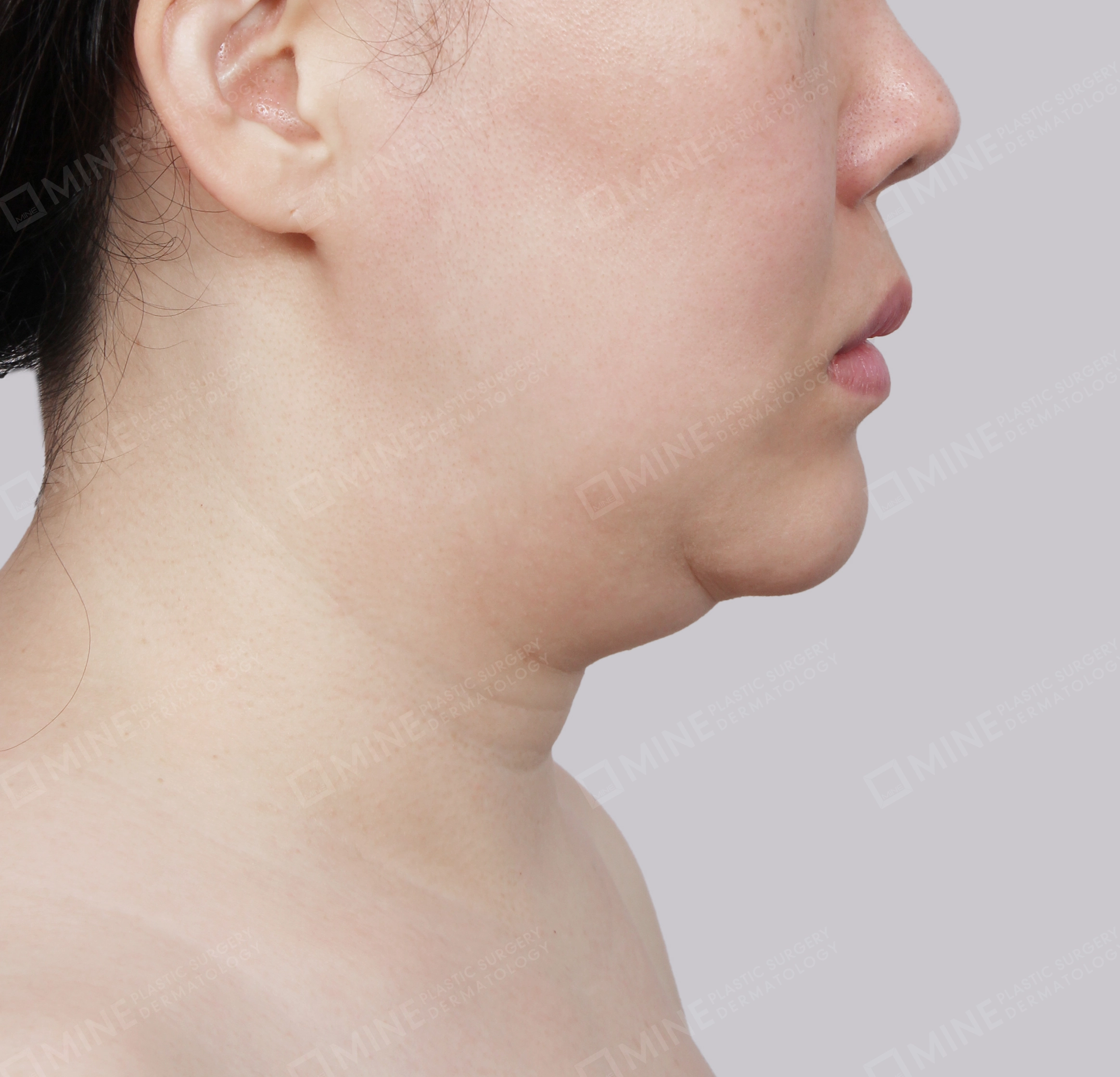 Mini Neck Lift-Side-Before