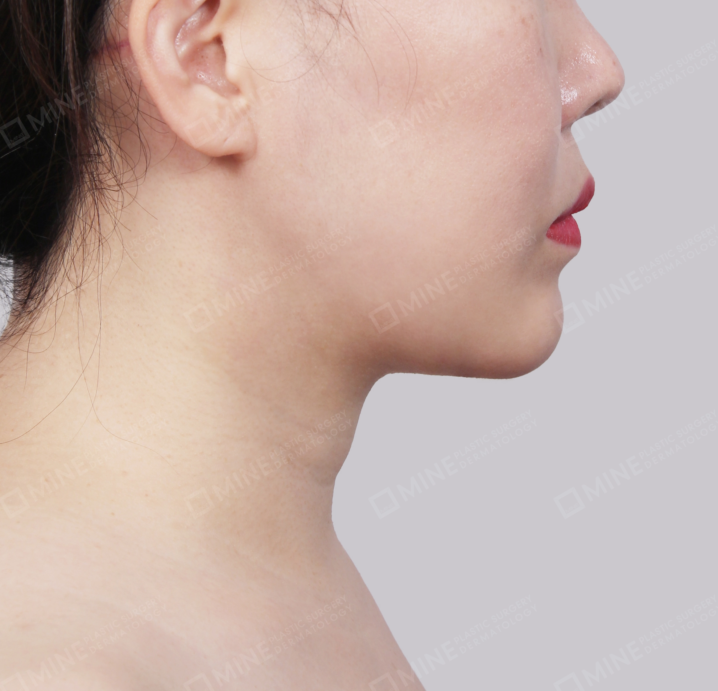 Mini Neck Lift-Side-After