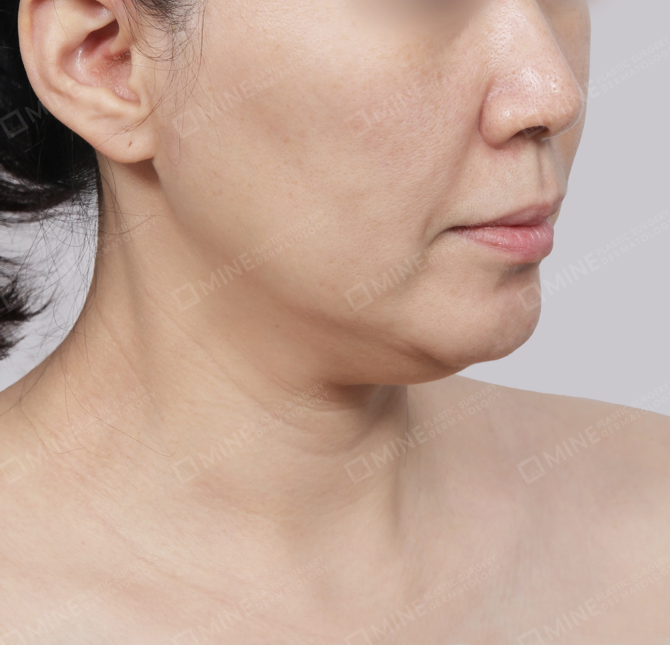 Mini Neck Lift-Front-Before
