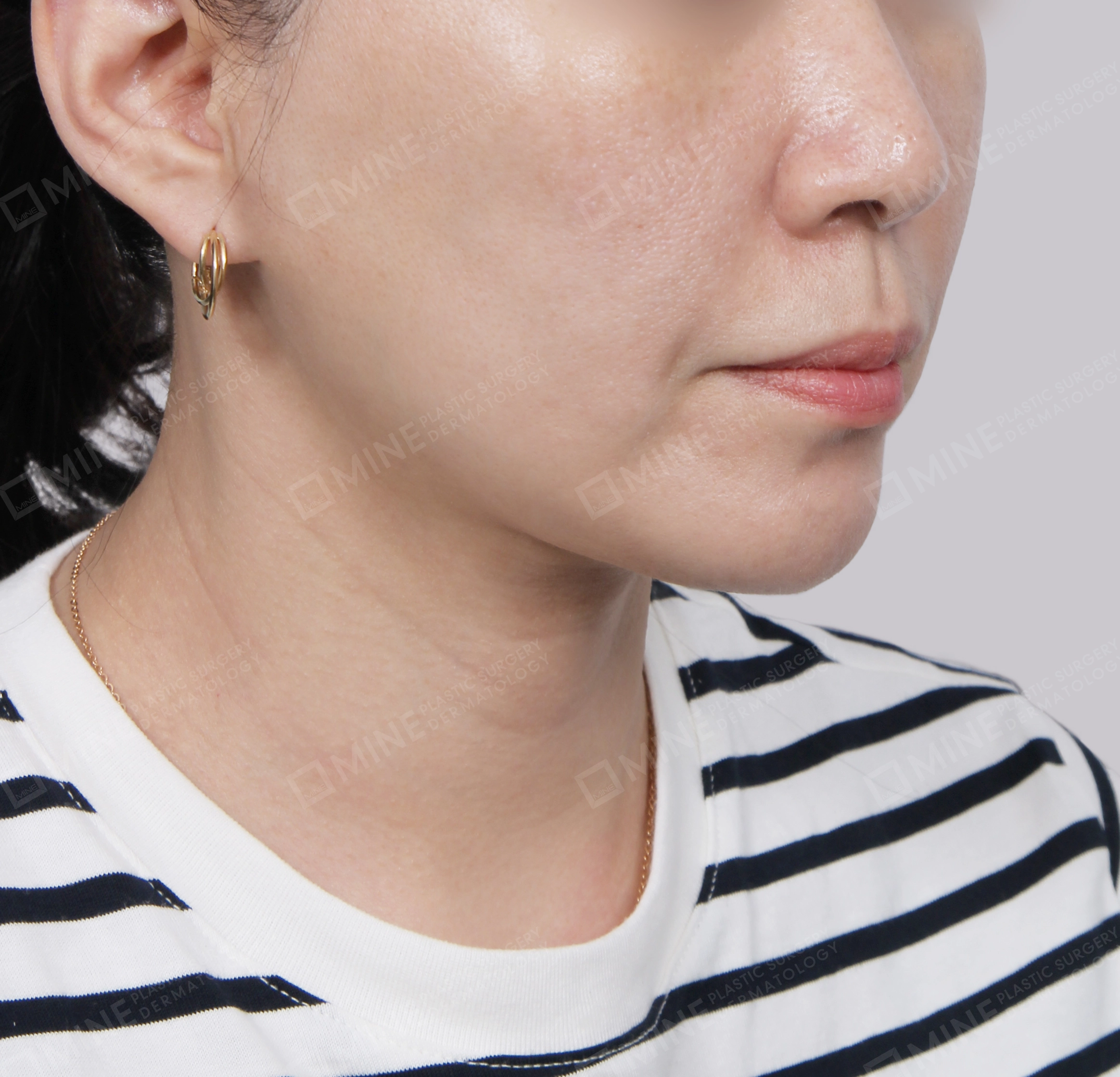 Mini Neck Lift-Front-After