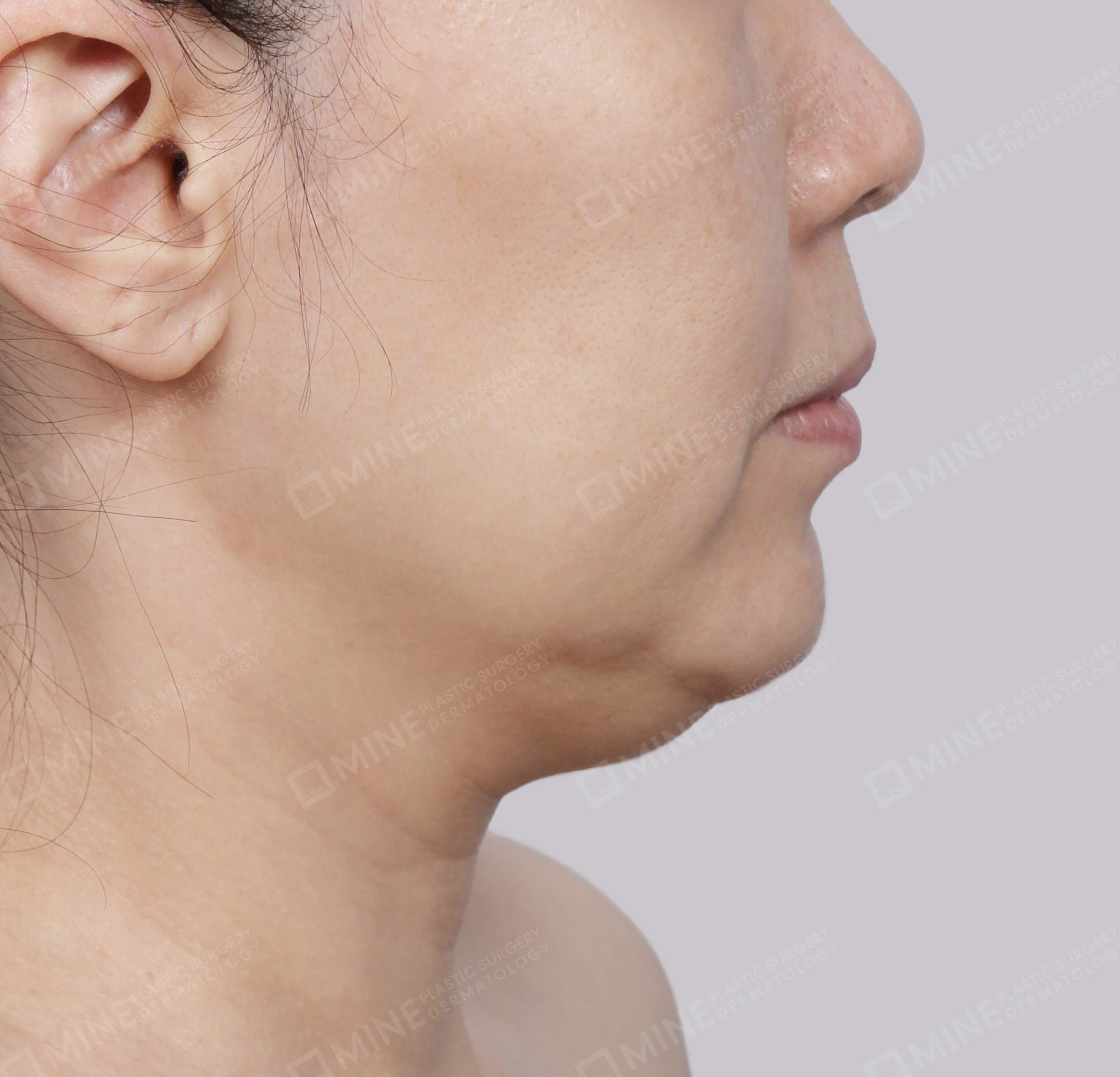Mini Neck Lift-Side-Before
