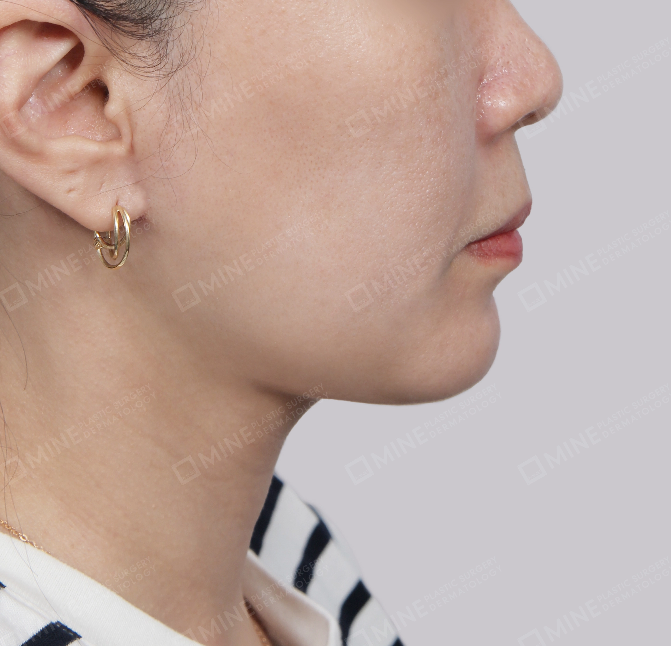 Mini Neck Lift-Side-After