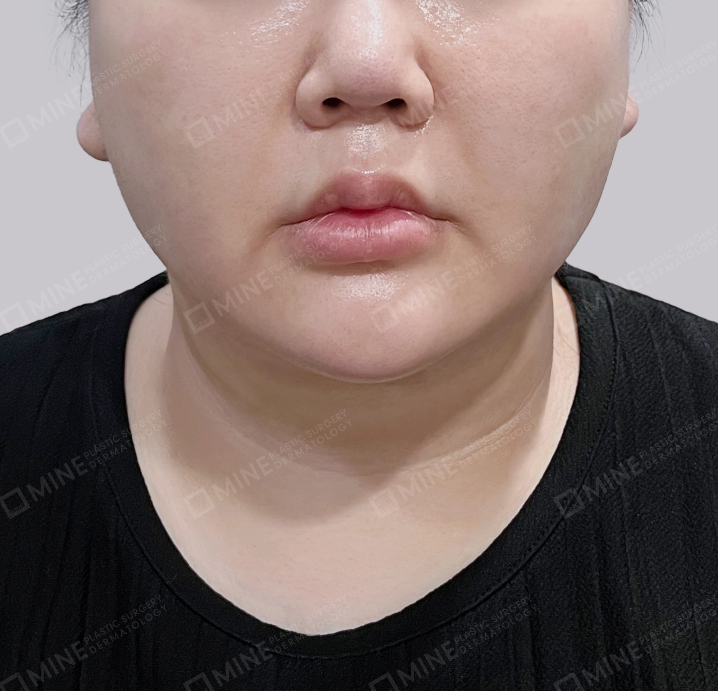 Mini Neck Lift-Front-After