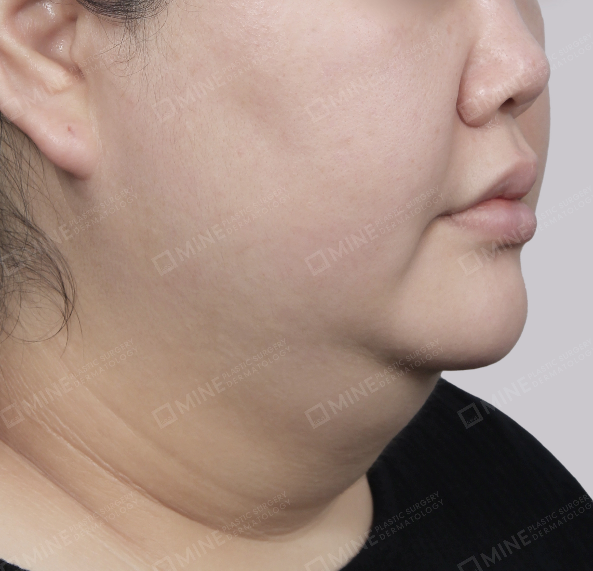 Mini Neck Lift-45-Degree-Before