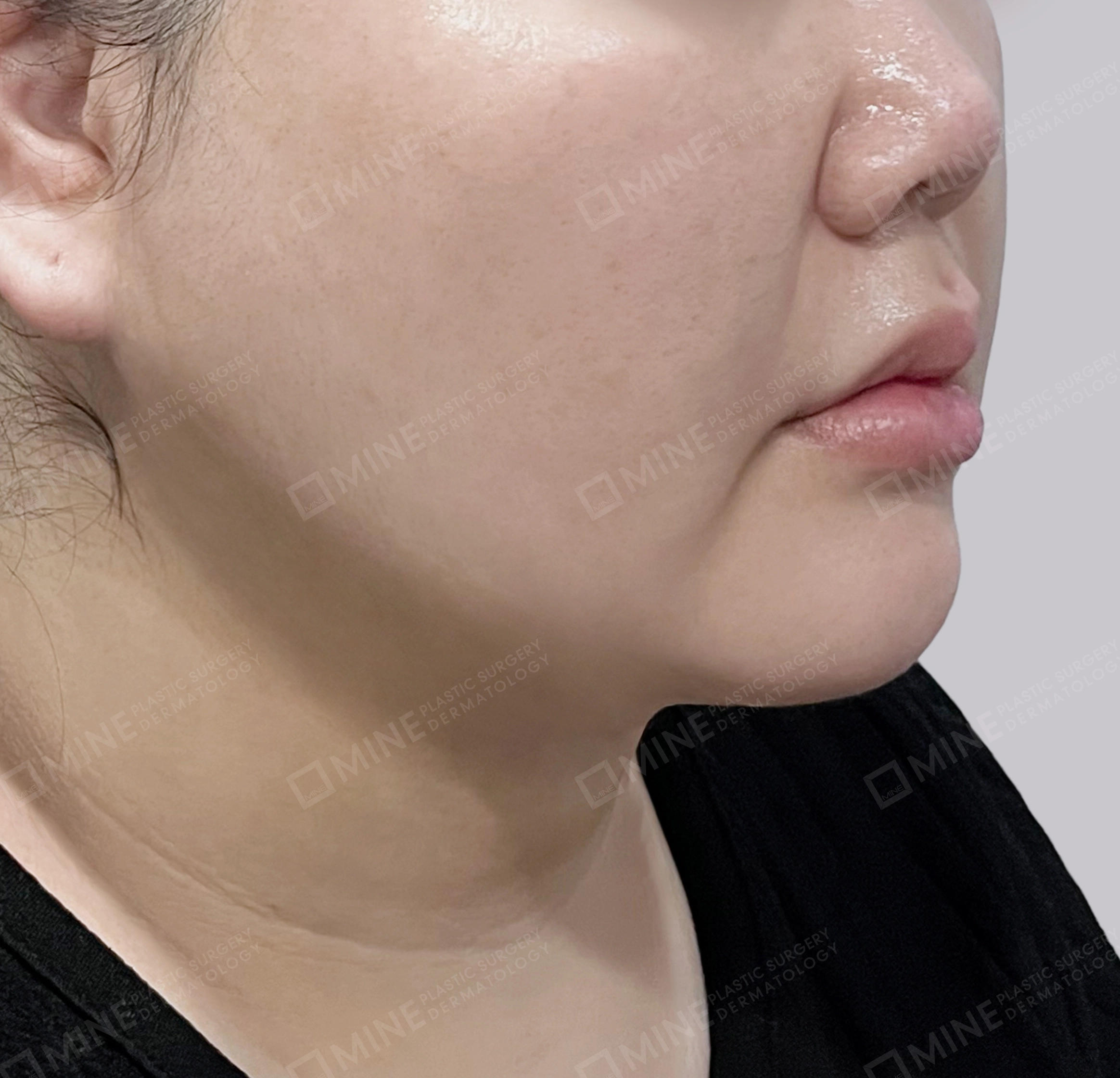 Mini Neck Lift-45-Degree-After