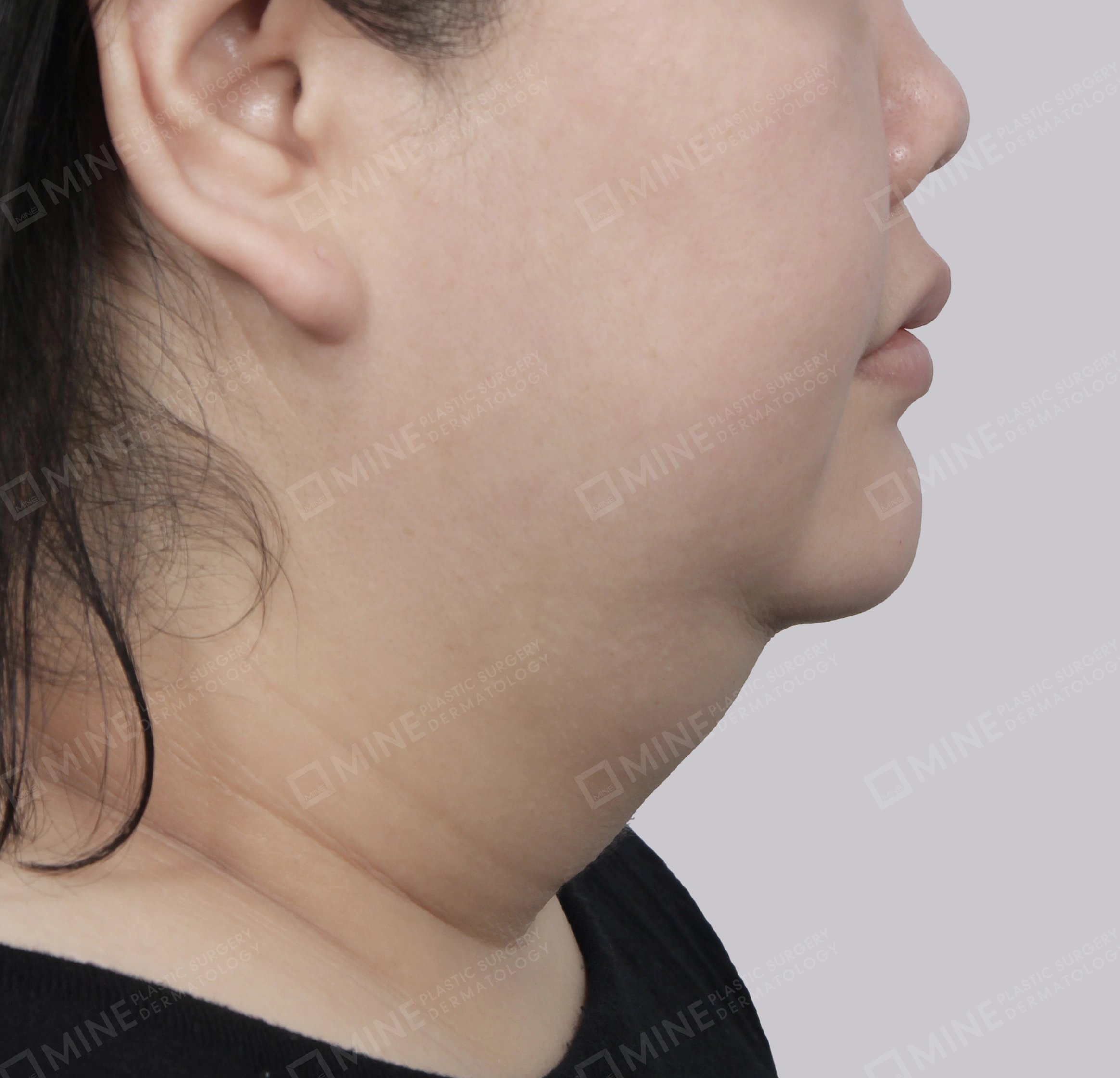 Mini Neck Lift-Side-Before